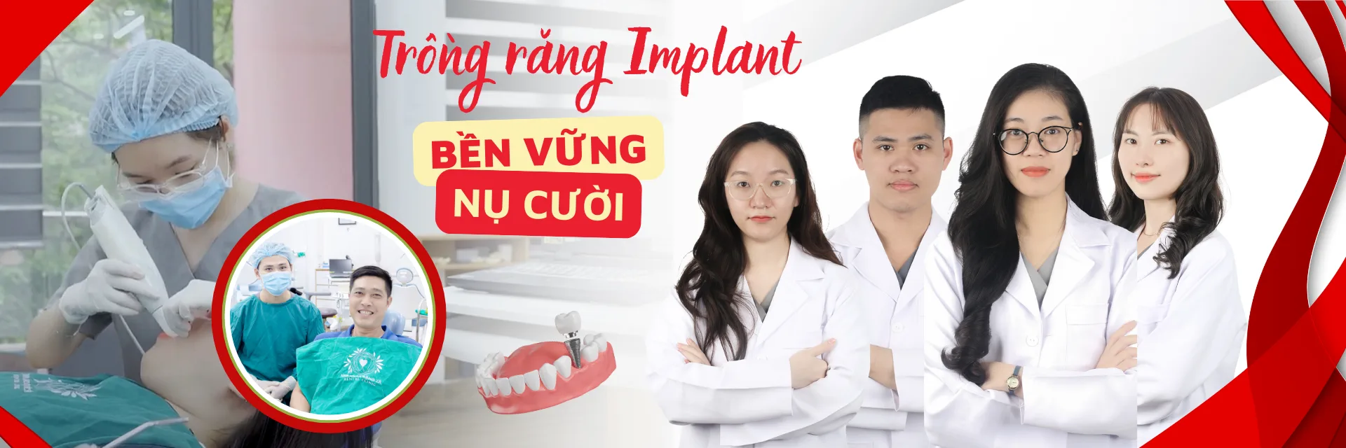 https://sdental.vn/storage/Trong-rang-Implant-1.png.webp