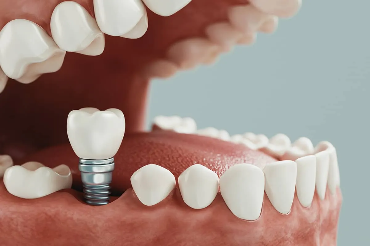 cay-ghep-implant-don-le cay-ghep-implant-don-le