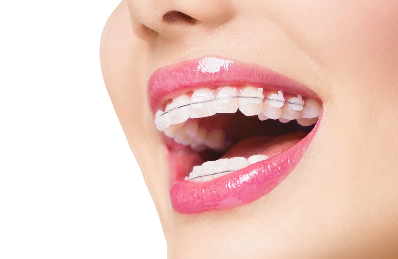 Tư Vấn Niềng Răng Mắc Cài Trong Suốt Ở Gia Lâm: Quy Trình và Lựa Chọn