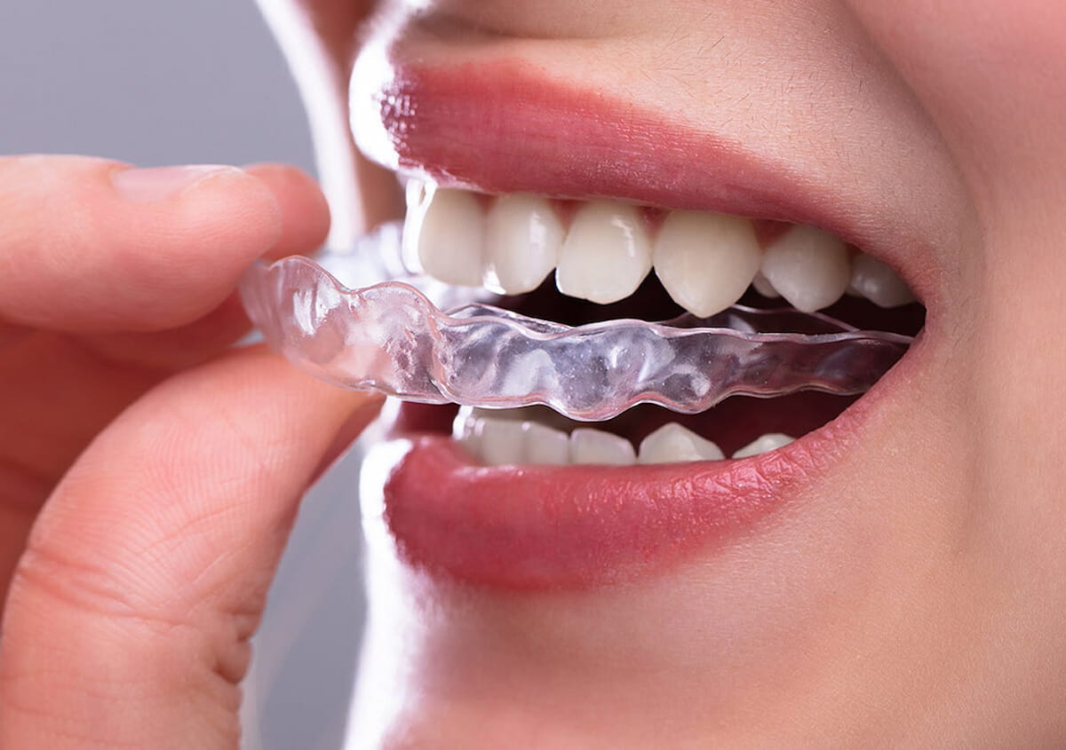 Niềng Răng Clear Aligner Ở Gia Lâm: Xu Hướng Chỉnh Nha Hiện Đại