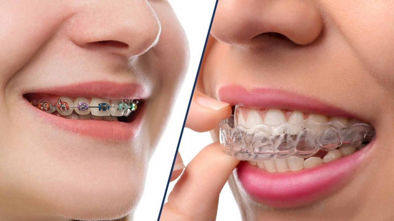 Báo giá niềng răng trong suốt ở Gia Lâm