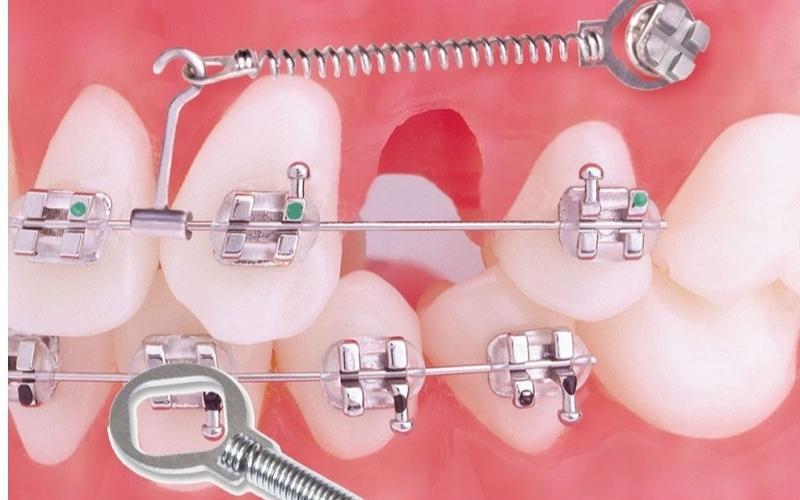 Nhổ Răng Chỉnh Nha & Đóng Khoảng: Hé Lộ Bí Mật Cơ Sinh Học Đằng Sau Nụ Cười Hoàn Hảo
