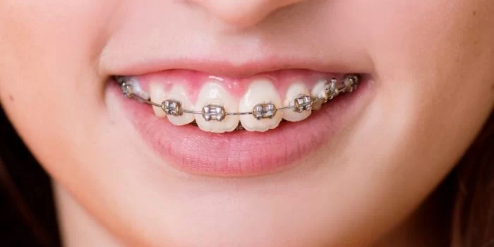 Niềng Răng Hô Ở Gia Lâm: Giải Pháp Cho Nụ Cười Tự Tin, Hài Hòa