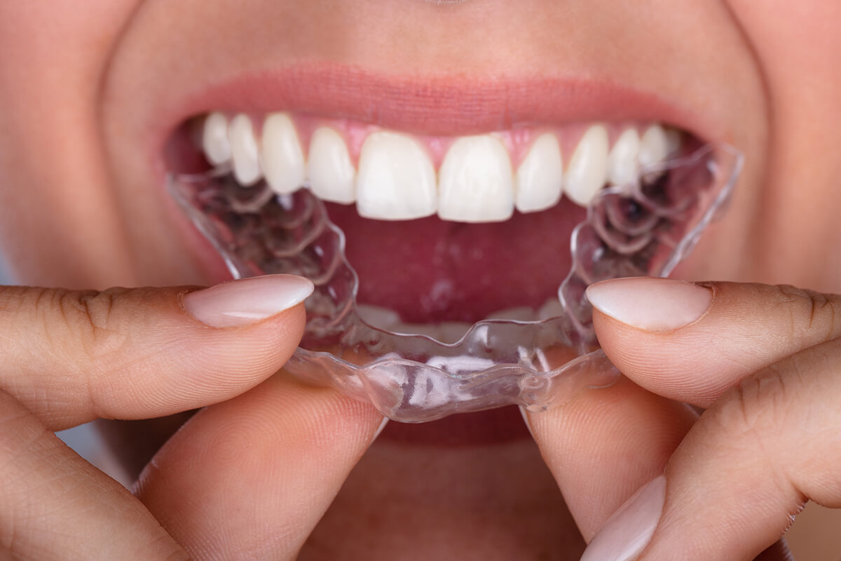nieng-rang-invisalign-1 nieng-rang-invisalign-1
