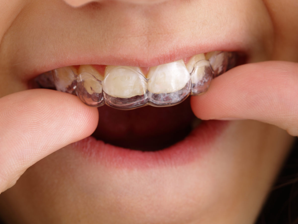 nieng-rang-invisalign-2 nieng-rang-invisalign-2