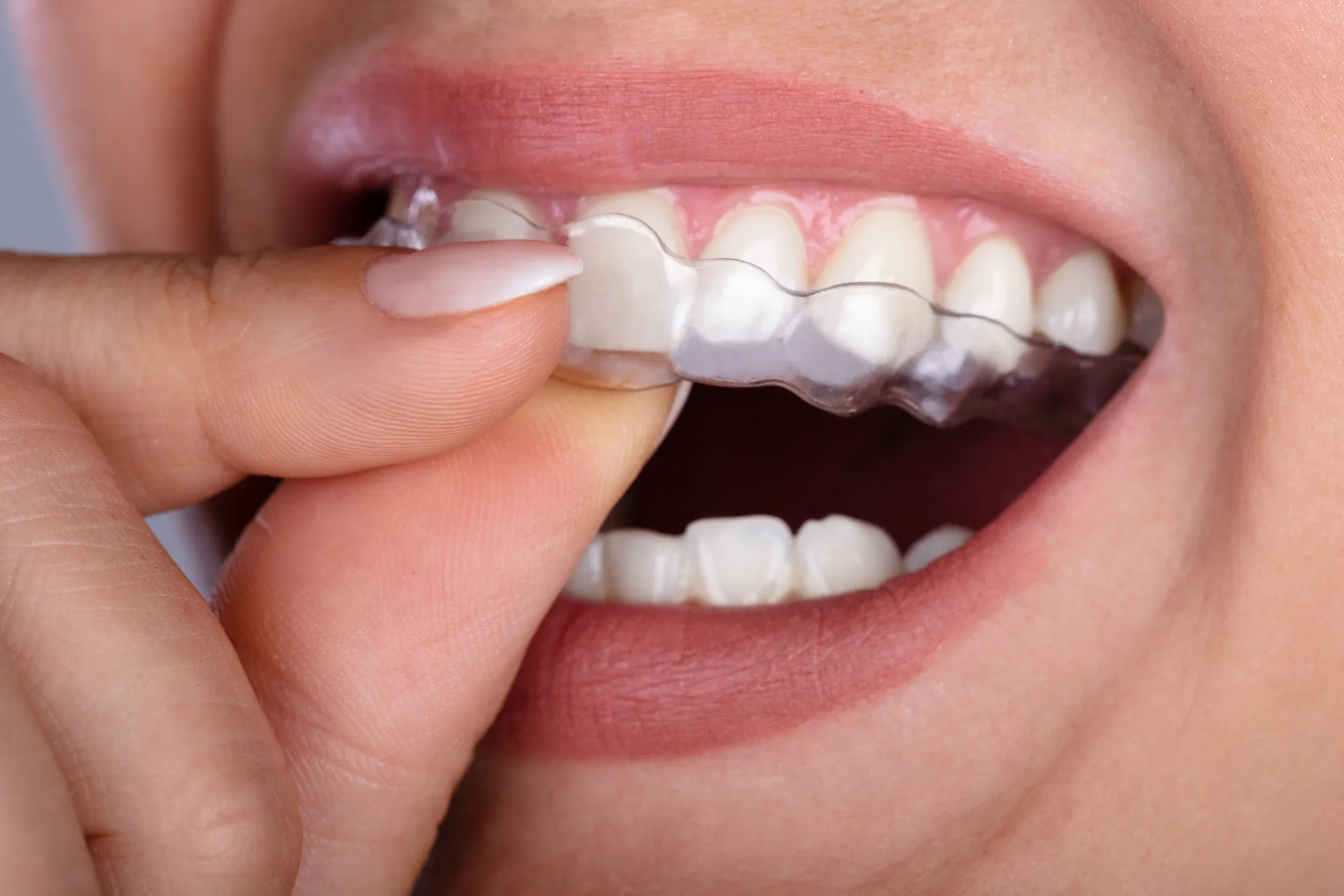nieng-rang-invisalign nieng-rang-invisalign