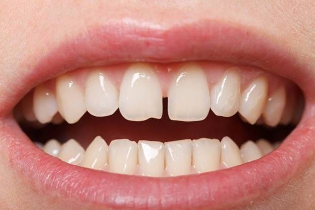 Niềng răng thưa 2 Niềng răng thưa 2