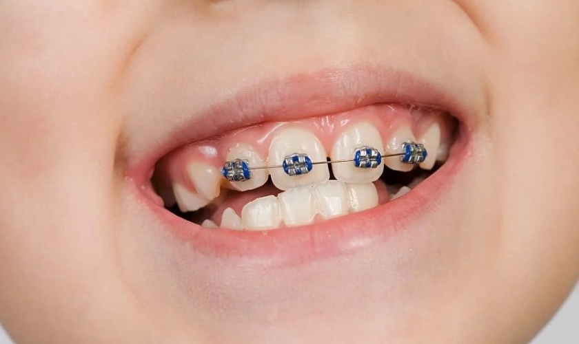 Niềng răng thưa 3 Niềng răng thưa 3
