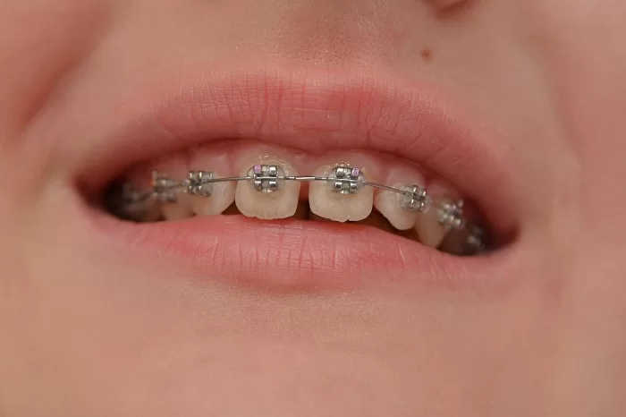 Niềng răng thưa 4 Niềng răng thưa 4