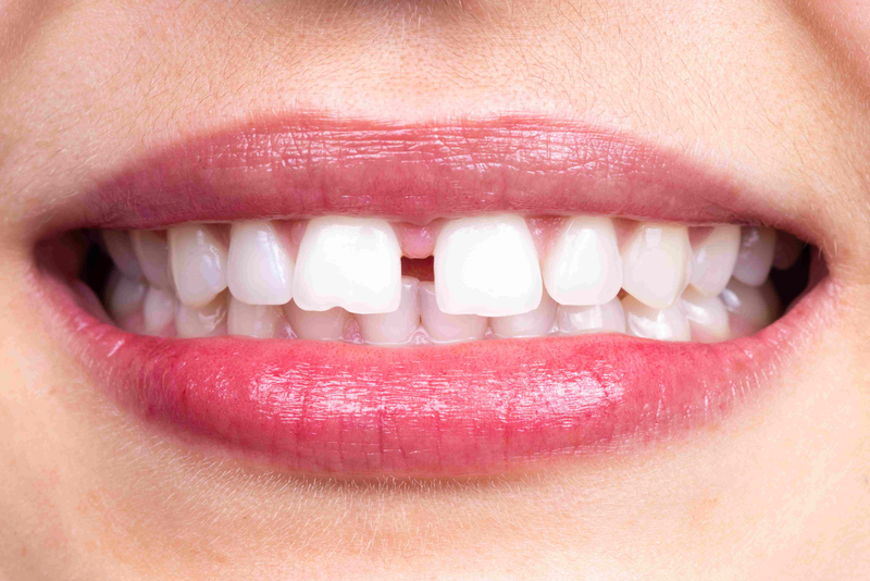 Phí Niềng Răng Thưa Ở Gia Lâm: Chi Tiết Và Cân Nhắc