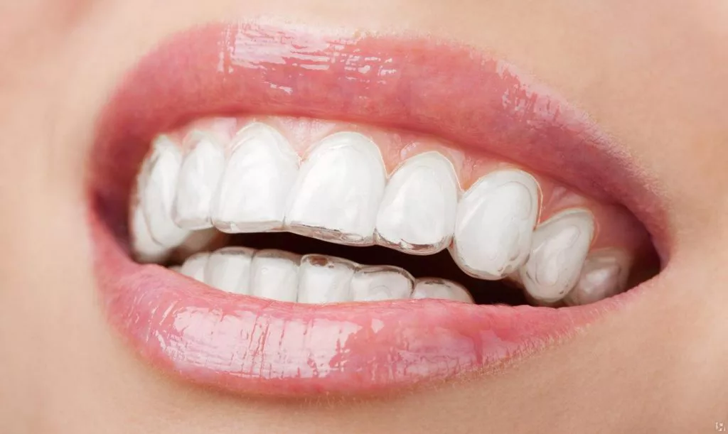 Chi Phí Niềng Răng Clear Aligner Ở Gia Lâm: Phân Tích Chi Tiết