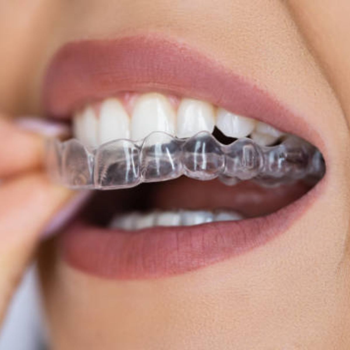 nieng-trong-suot-Invisalign nieng-trong-suot-Invisalign