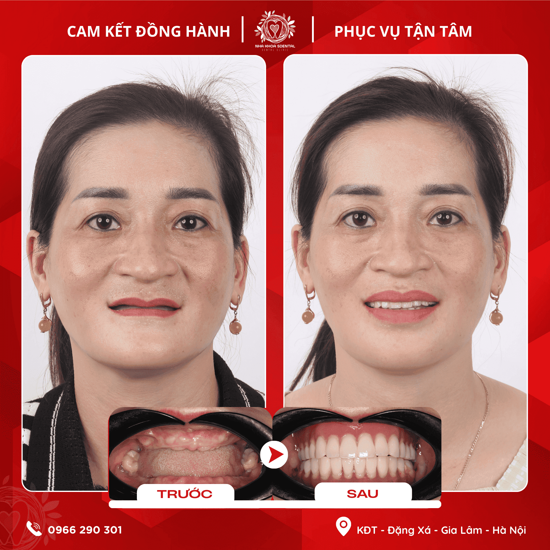 Cấy Ghép Implant Toàn Hàm: Câu Chuyện Tìm Lại Nụ Cười Của Chị Đỗ Thị Thanh Tâm Tại S-Dental