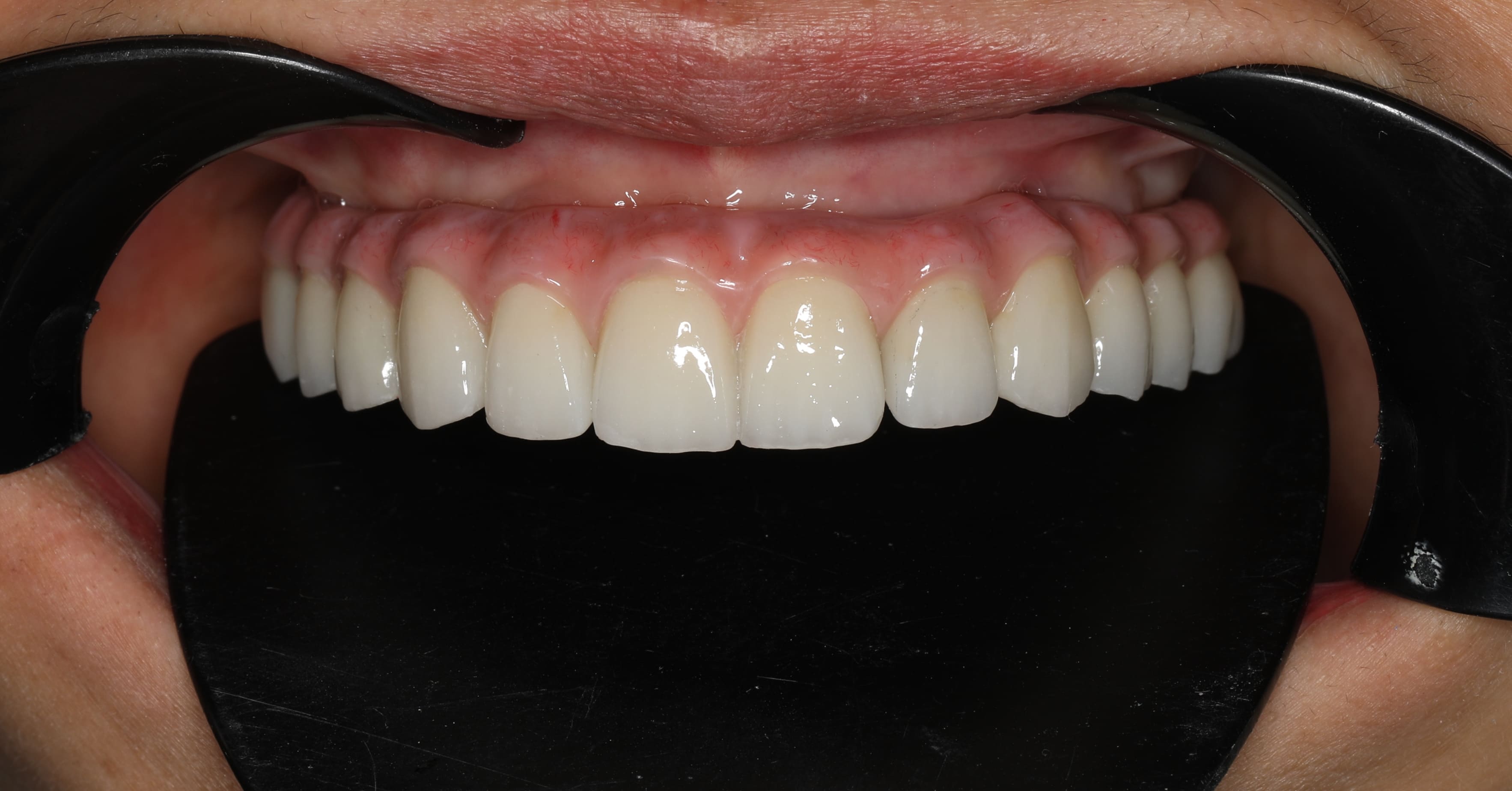 Phục hình răng sứ - Cô Bình Phục hình răng sứ - Cô Bình