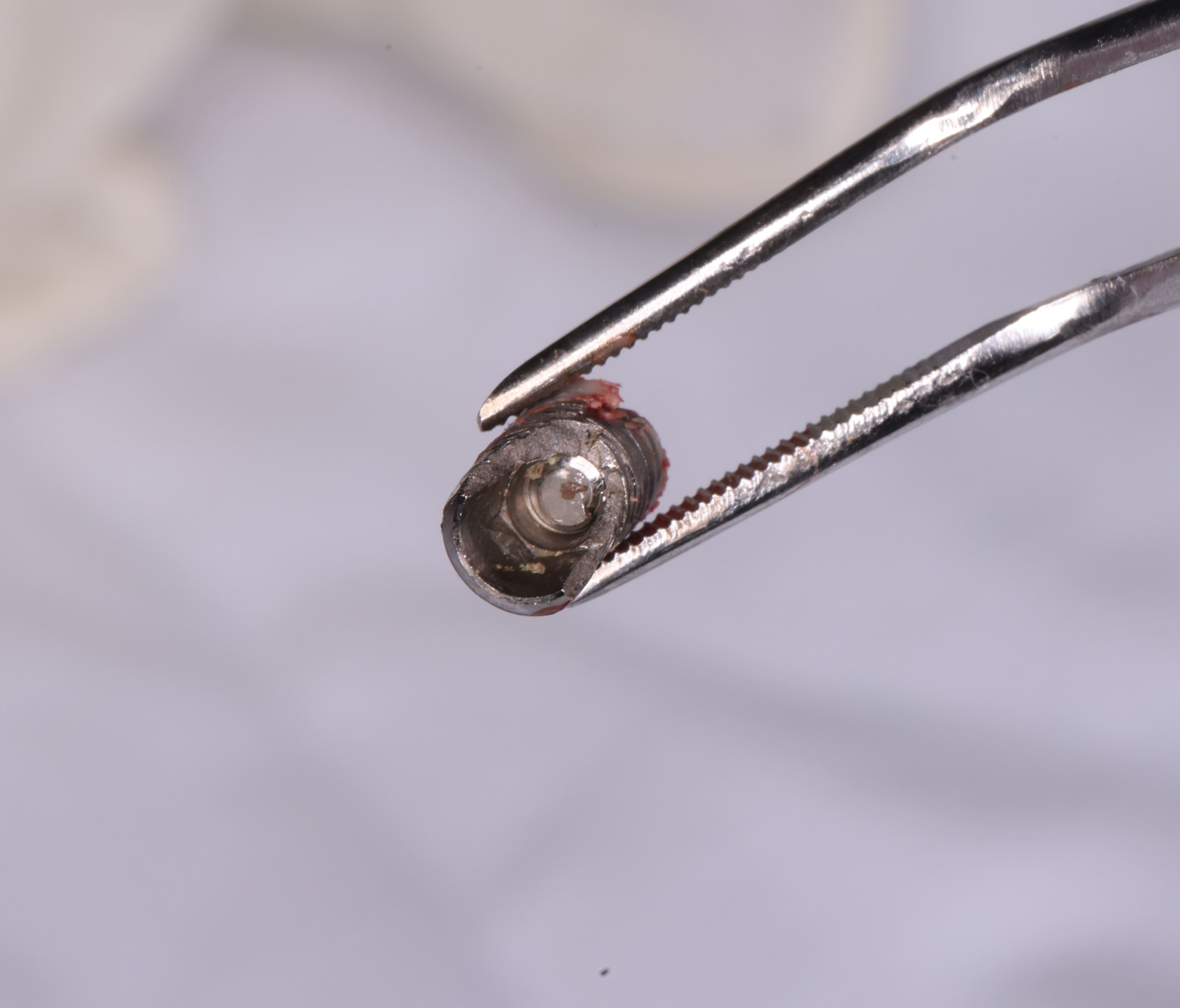 Vỡ Trụ Implant: Hành Trình Trồng Implant Mới Của Chú Lê Minh Lư Tại S-Dental