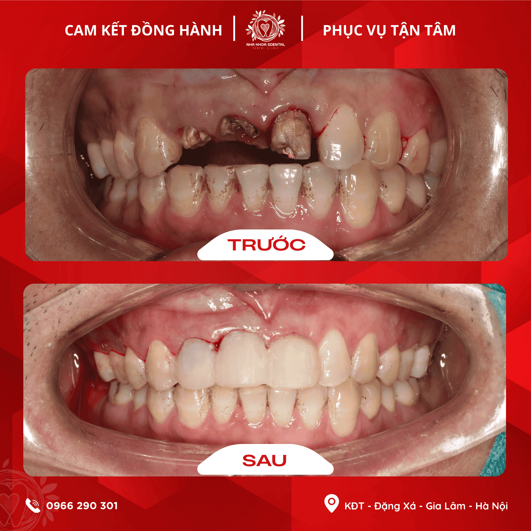 Nhổ Và Trồng Implant Vùng Răng Cửa: Hành Trình Lấy Lại Nụ Cười Của Anh Nguyễn Quốc Đỉnh