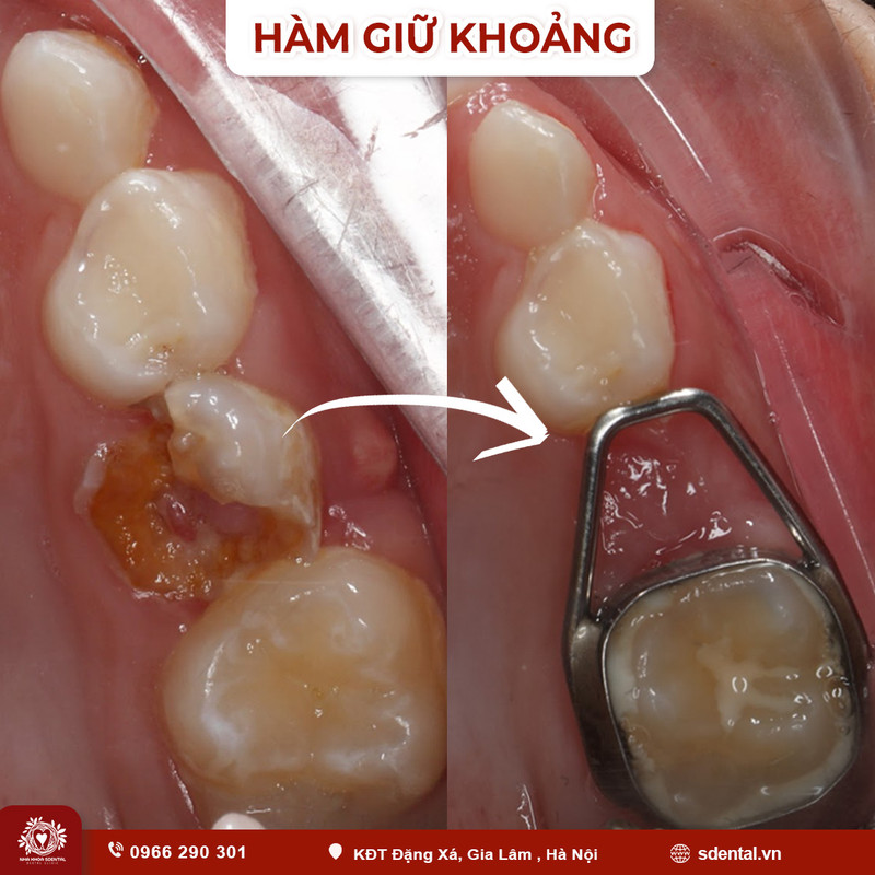 ham-giu-khoang-3